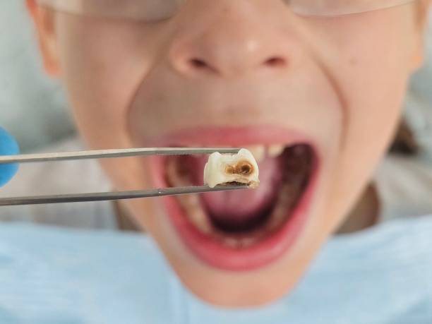 Best Chipped Tooth Repair Near Me  in Tappan, NY